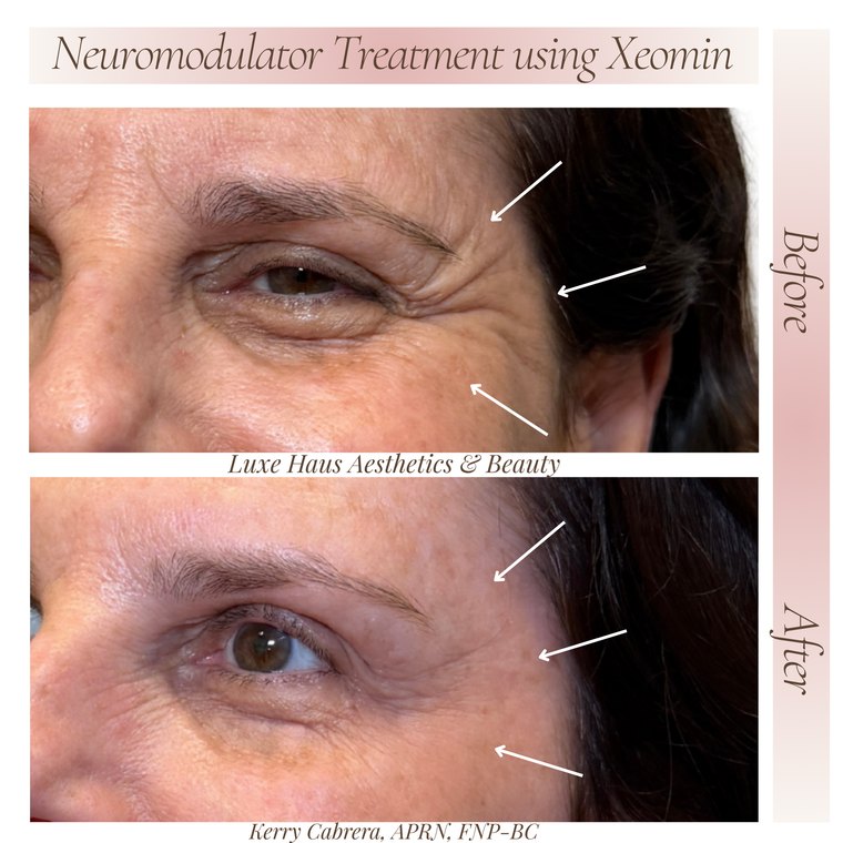 Botox / neuromodulator before and after at Luxe Haus Aesthetics & Beauty in Coral Springs, FL.