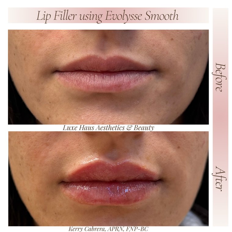 Dermal filler before and after at Luxe Haus Aesthetics & Beauty in Coral Springs, FL.