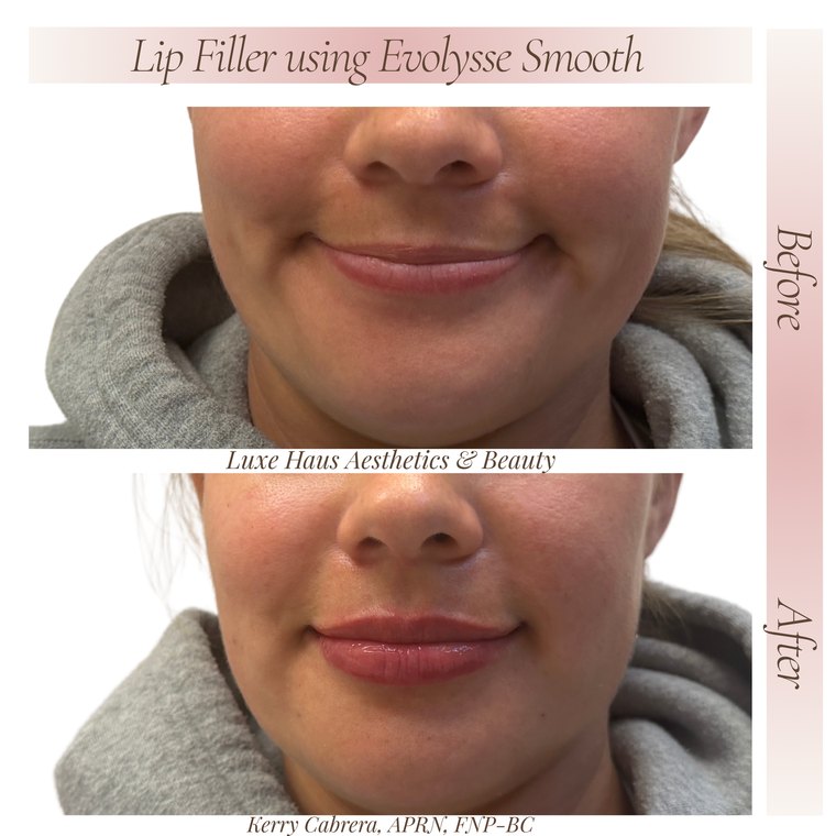 Dermal filler before and after at Luxe Haus Aesthetics & Beauty in Coral Springs, FL.
