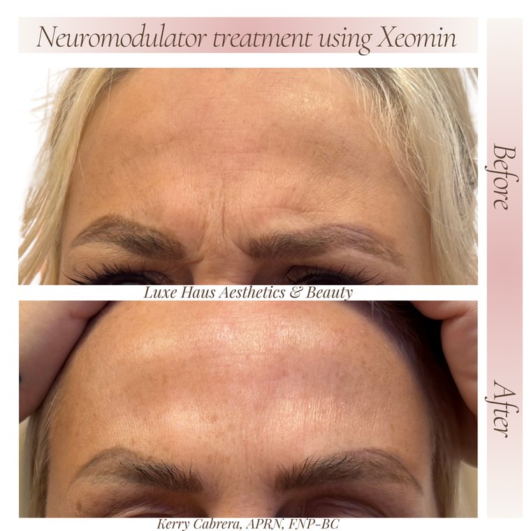 Botox / neuromodulator before and after at Luxe Haus Aesthetics & Beauty in Coral Springs, FL.