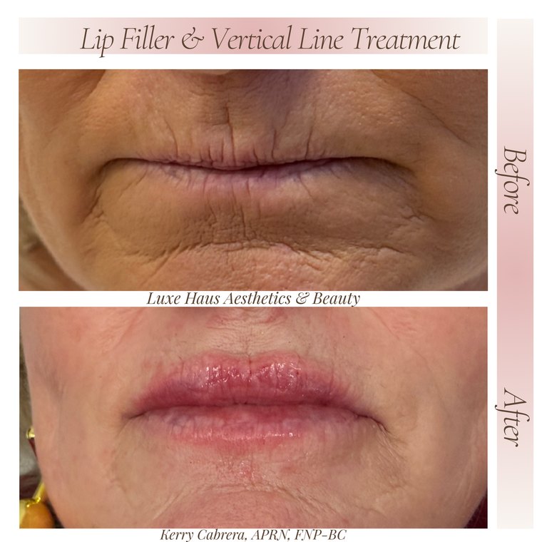 Dermal filler before and after at Luxe Haus Aesthetics & Beauty in Coral Springs, FL.