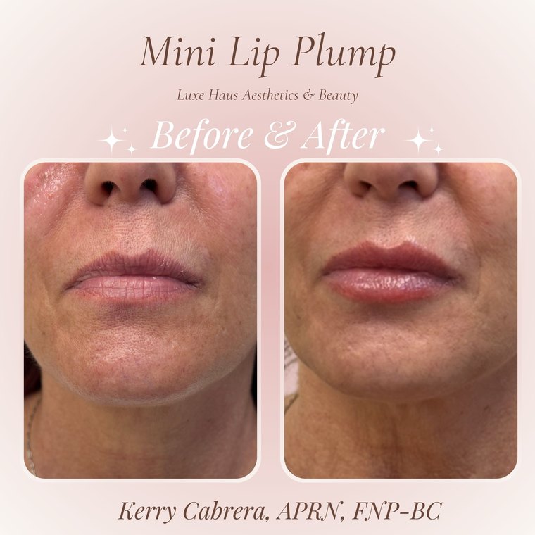 Dermal filler before and after at Luxe Haus Aesthetics & Beauty in Coral Springs, FL.