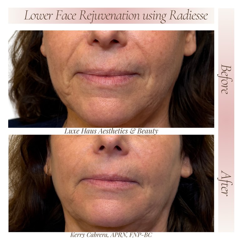 Dermal filler before and after at Luxe Haus Aesthetics & Beauty in Coral Springs, FL.